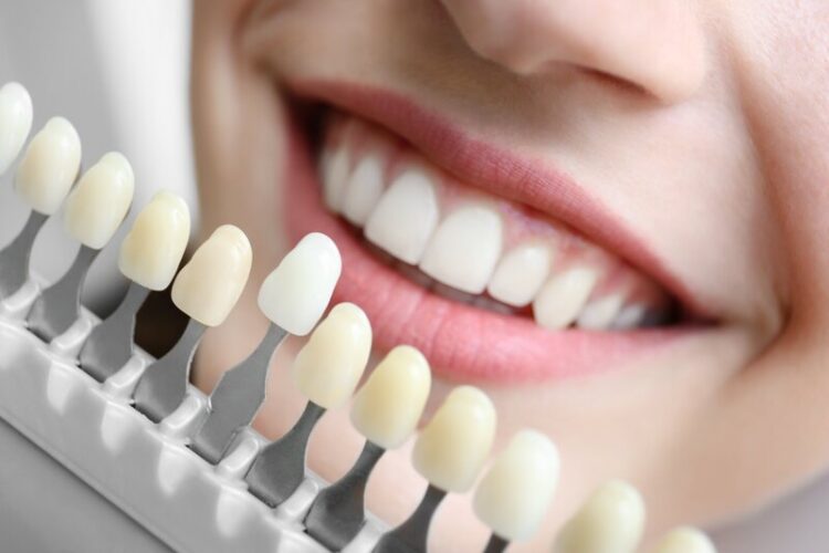 Bleaching bzw. professionelle Zahnaufhellung Gießen - für strahlend weiße Zähne