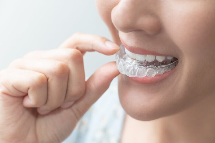 Clear Aligner Giessen – die unsichtbare Zahnspange zum Herausnehmen