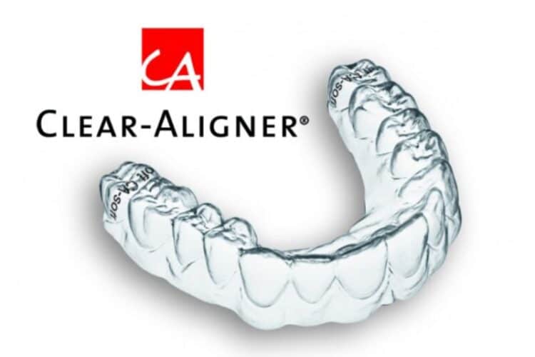 Herausragende Vorteile der Clear-Aligner - Zahnarzt Gießen Dr. Röder