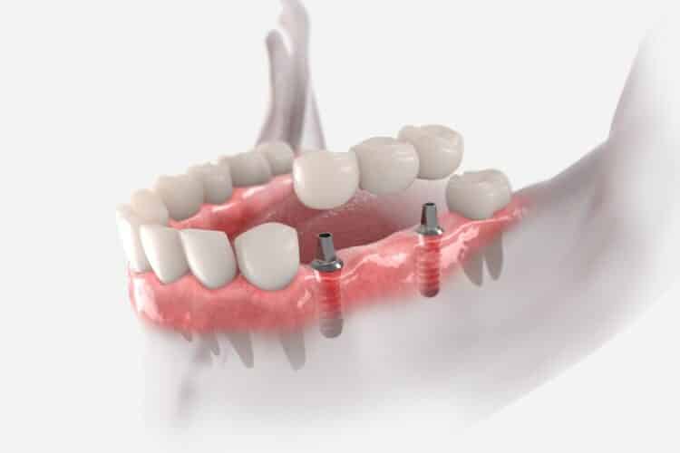 Implantate Gießen - Implantatgetragener Zahnersatz für ein dauerhaft komfortables Beißgefühl