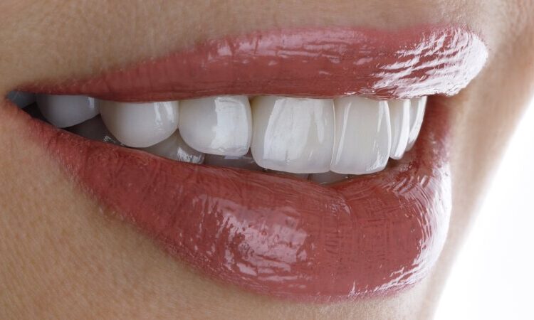 Veneers in Gießen für einen perfekten Look