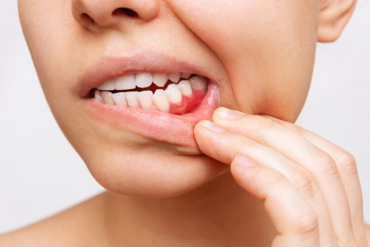 Was hilft gegen Zahnfleischbluten - Ihr Zahnarzt Giessen