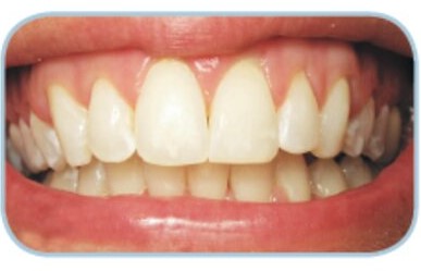 Zahnkorrektur mit Six Month Smiles® Brackets Gießen Vorher