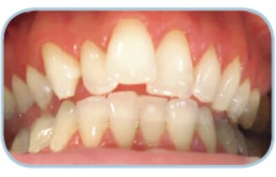 Zahnkorrektur mit Six Month Smiles® Brackets Gießen Vorher