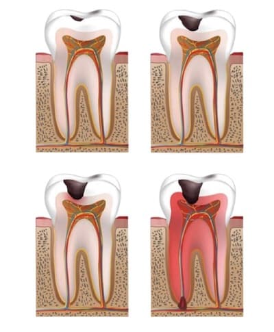 Die verschiedenen Stadien von Karies erklärt - Zahnarzt Gießen