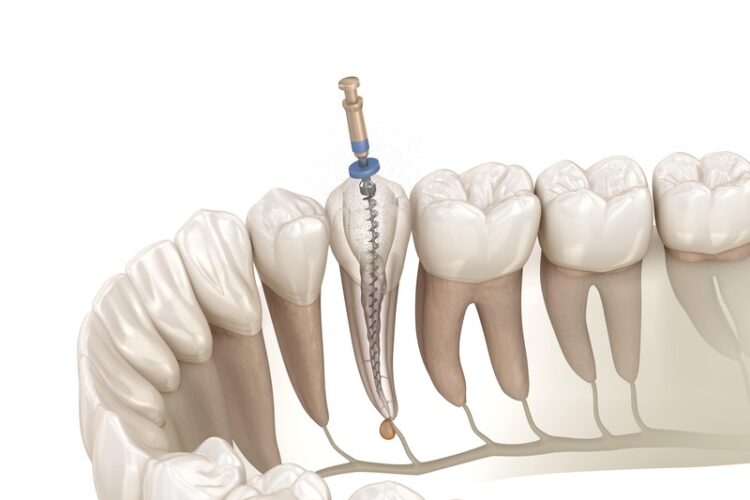 Karies - Wurzelbehandlung oder Zahn ziehen wenn Zahn nicht mehr zu retten ist - Zahnarzt Gießen