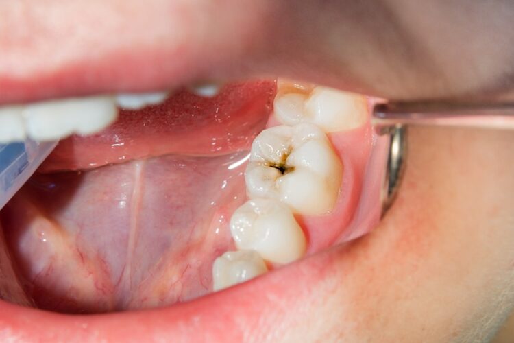 Was genau ist Karies und wie entsteht Zahnfäule - Zahnarzt Gießen - Zahnzentrum Dr. Röder und Kollegen