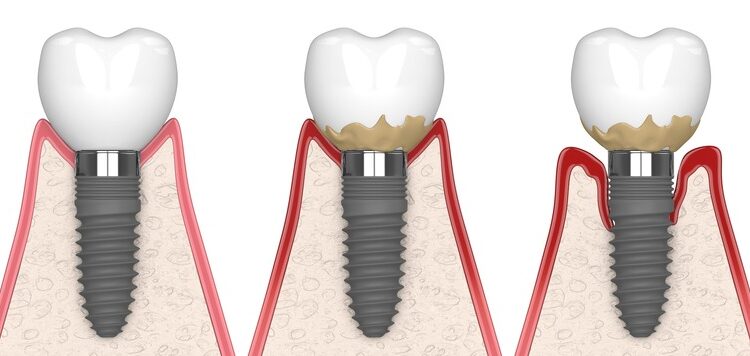 Parodontitis auch eine Gefahr für Implantate - Zahnarzt Gießen - Zahnzentrum Dr. Röder und Kollegen