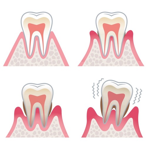 Parodontose Gießen - Was ist Parodontitis und wie entsteht sie