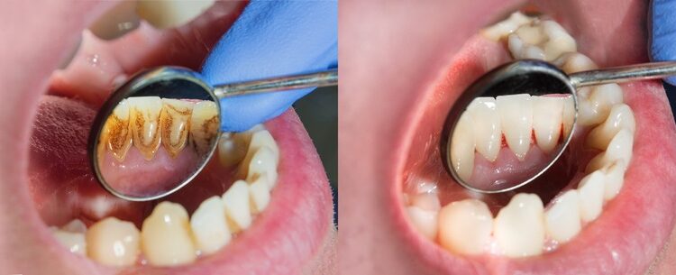 Welche Vorteile hat eine PZR in unserer Zahnarztpraxis in Gießen