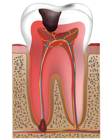 Was ist eine Zahnwurzelentzündung? Zahnarzt Gießen - Zahnzentrum Dr. Röder und Kollegen
