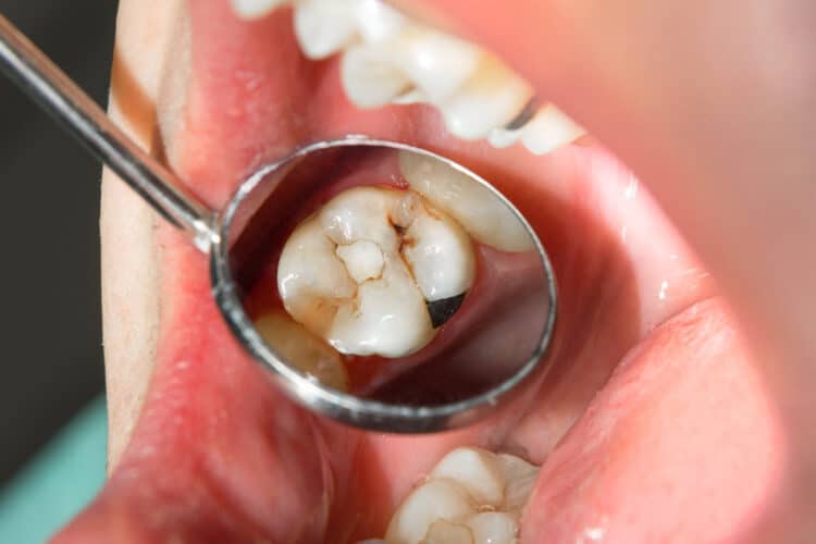 Zahnfüllungen Wetzlar - hochwertige Füllungstherapie