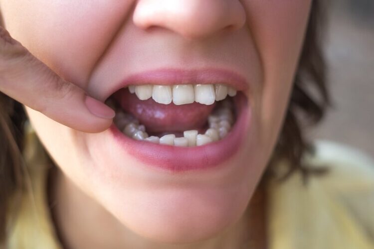 Für wen eignen sich die SIX MONTH SMILES Brackets - Zahnarzt Gießen, Zahnzentrum Dr. Röder und Kollegen