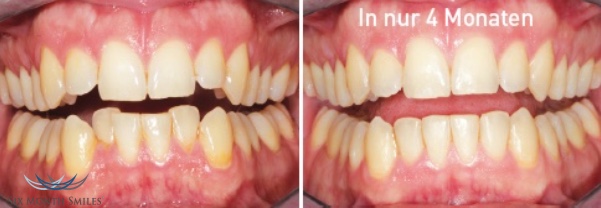 Vorher und Nachher - Six Month Smiles Zahnkfehlstellungskorrektur