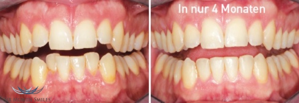 Vorher und Nachher - Six Month Smiles Zahnkfehlstellungskorrektur