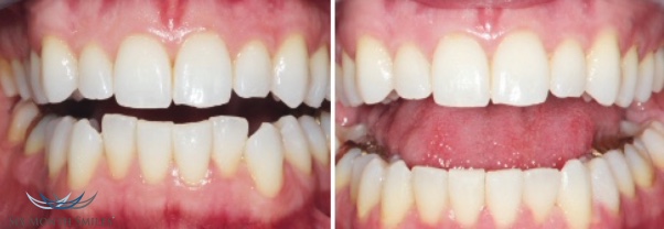 Vorher und Nachher - Six Month Smiles Zahnkorrektur - schöne gerade Zähne in nur 6 Monaten