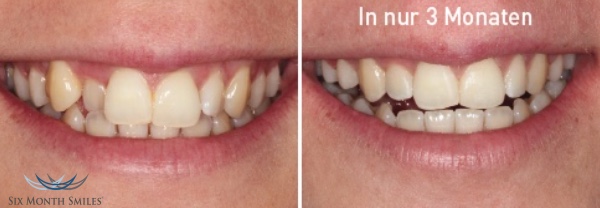Vorher und Nachher - Six Month Smiles Zahnkorrektur