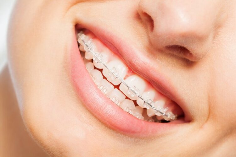 Wie funktioniert die Zahnstellungskorrektur mit dem SIX MONTH SMILES Brackets? Zahnarzt Gießen - Zahnzentrum Dr. Röder und Kollegen