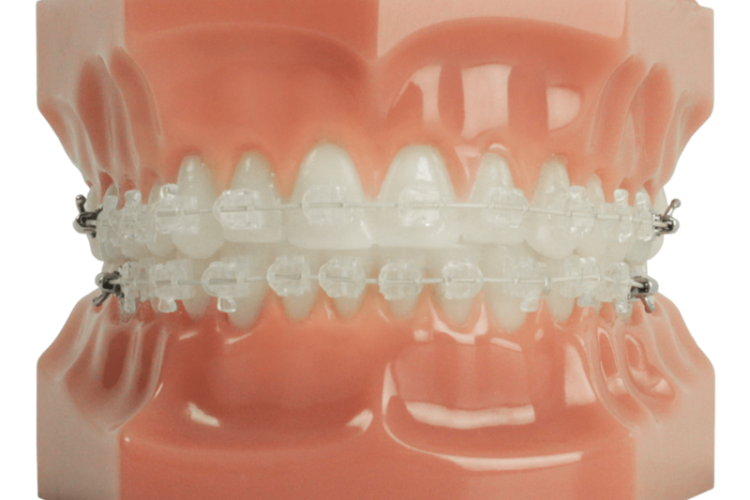 Wieviel kostet eine Zahnstellungskorrektur mit einer SIX MONTH SMILES Zahnspange - Zahnarzt Gießen